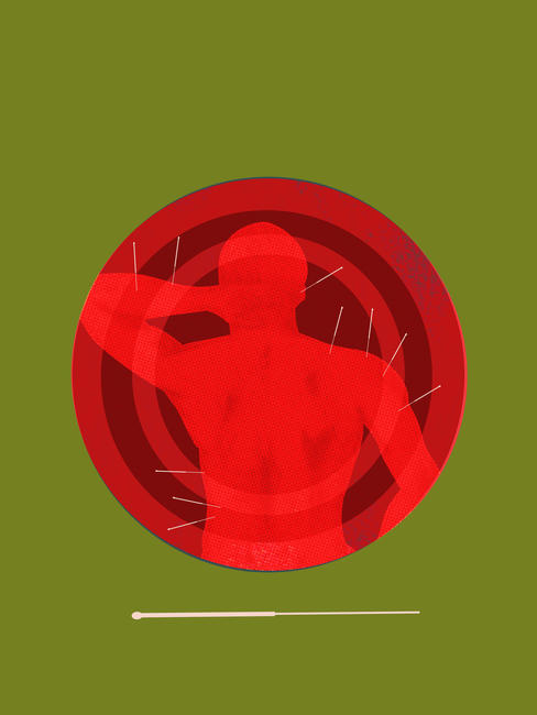 Acupuncture