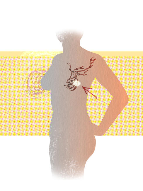 Breast cancer II