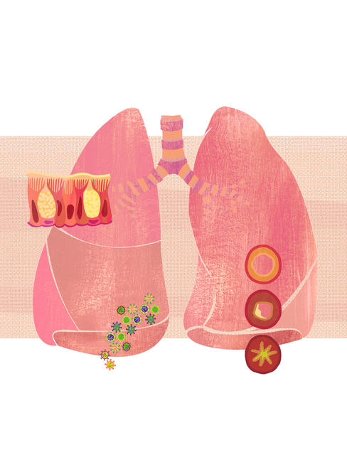 Bronchitis (book cover artwork)