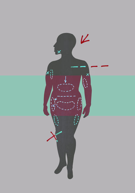 Liposuction