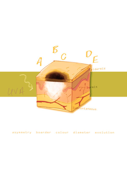Melanoma