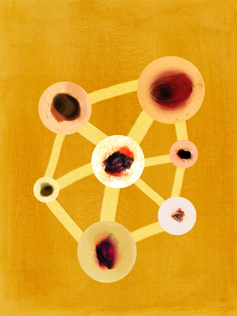 Melanoma excision
